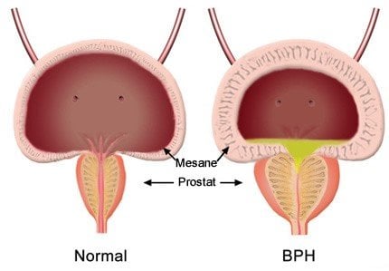 İyi Huylu Prostat Büyümesi (BPH)