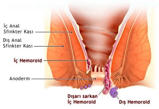 Hemoroid (Basur)