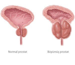 Akut ve Kronik Prostatit
